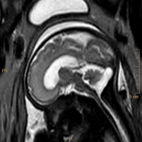 figure 3 diencephalosynapsis