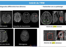 webinar démences