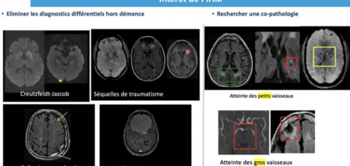 webinar démences